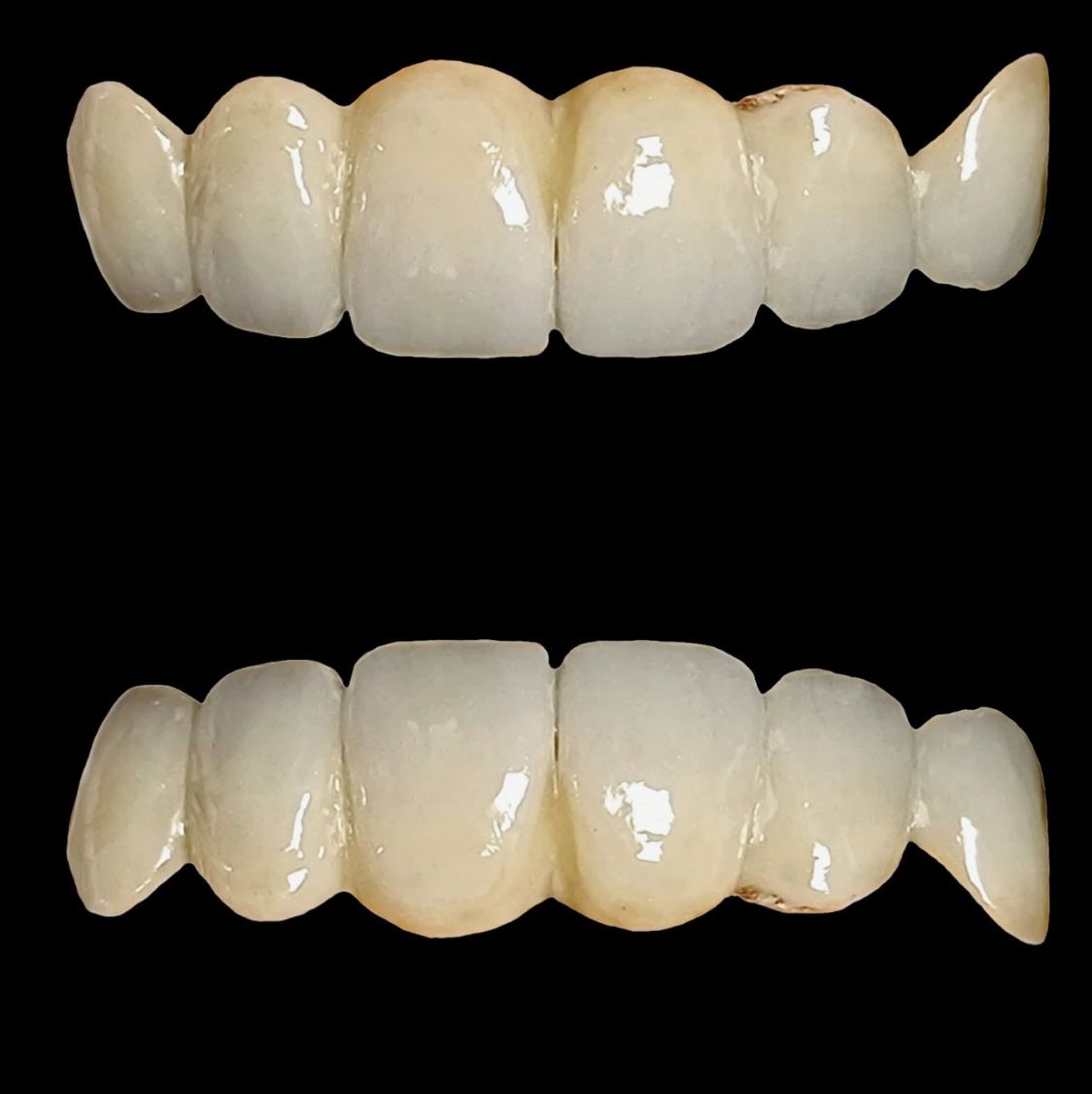 protesis_dental_fija